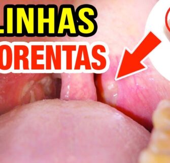 ACABE com as BOLINHAS FEDORENTAS da Garganta