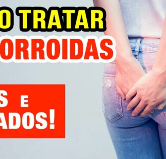 Como Tratar Hemorroidas Sem Cirurgia - 100% NATURAL