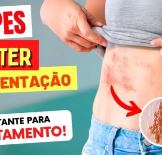 HERPES ZÓSTER - Alimentação CERTA no Tratamento e Sequelas