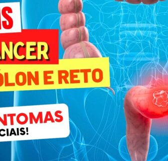 6 SINTOMAS INICIAIS de CÂNCER de CÓLON e RETO que você NÃO PODE IGNORAR!