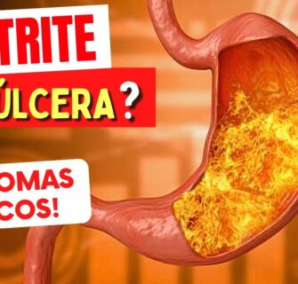GASTRITE VIRA ÚLCERA? Sintomas e Riscos que Você Precisa Conhecer